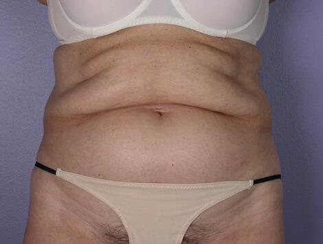 Tummy Tuck before photo