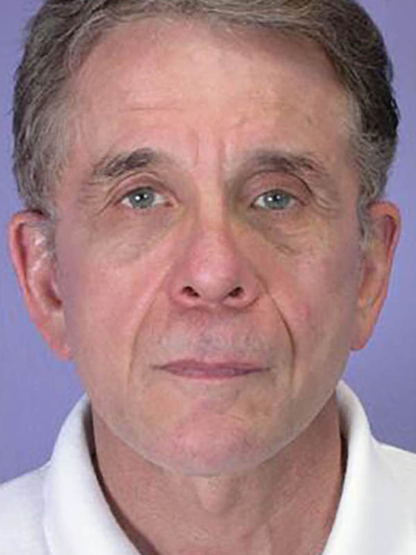 Facelift result at Marina Plastic Surgery