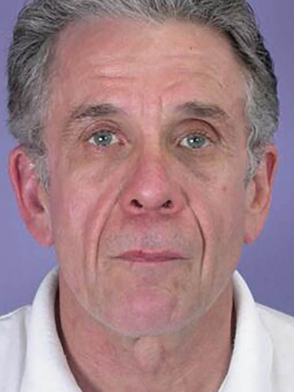 Facelift before photo