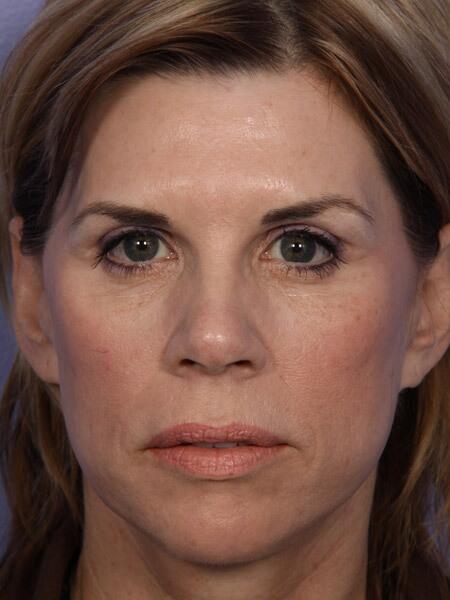 Facelift result at Marina Plastic Surgery