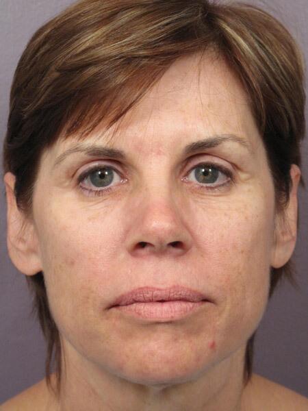 Facelift before photo