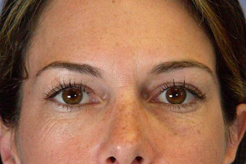 Blepharoplasty result at Marina Plastic Surgery