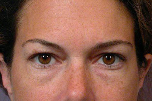 Blepharoplasty before photo