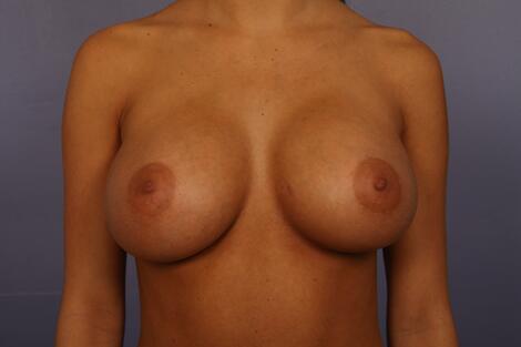 Breast Augmentation result at Marina Plastic Surgery