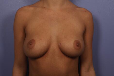 Breast Augmentation before photo