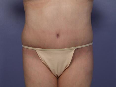 Tummy Tuck result at Marina Plastic Surgery
