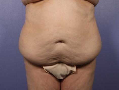 Tummy Tuck before photo