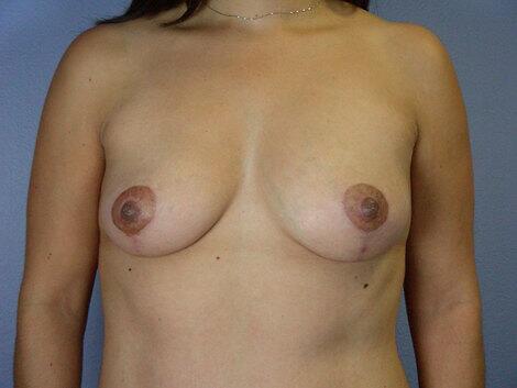 Breast Lift result at Marina Plastic Surgery