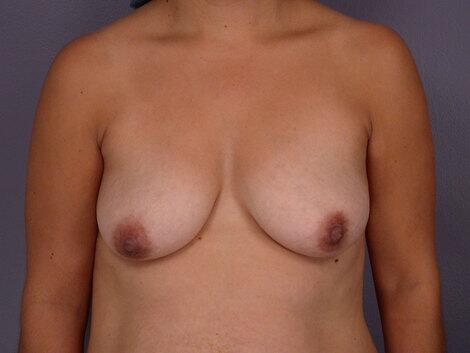 Breast Lift before photo