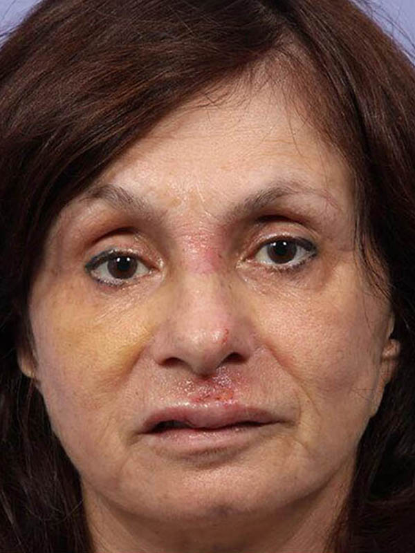 Rhinoplasty before photo