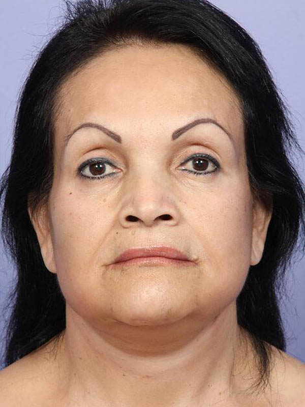 Facelift result at Marina Plastic Surgery