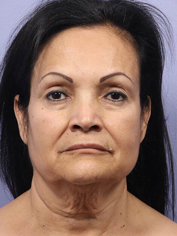 Facelift before photo