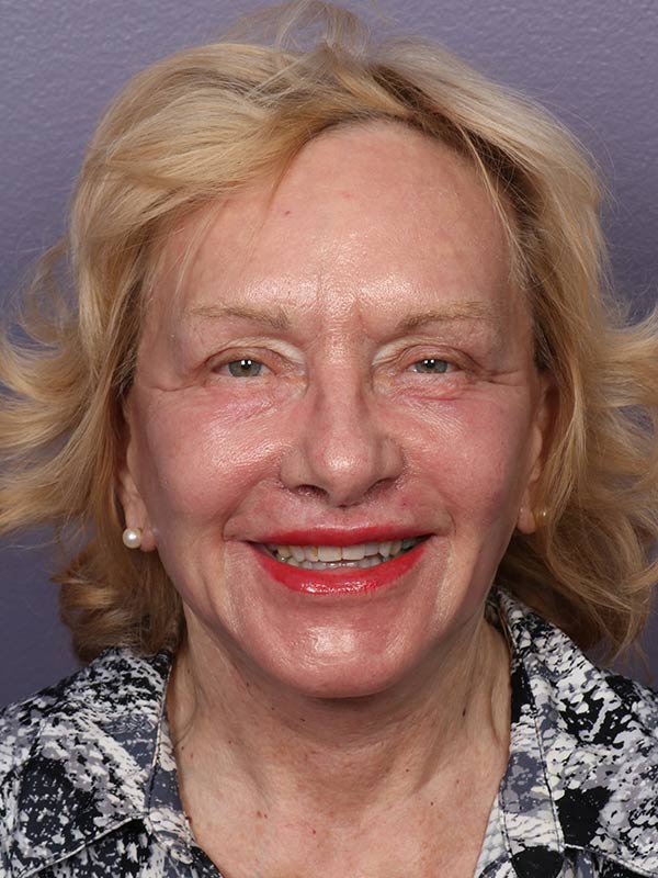 Neck Lift result at Marina Plastic Surgery