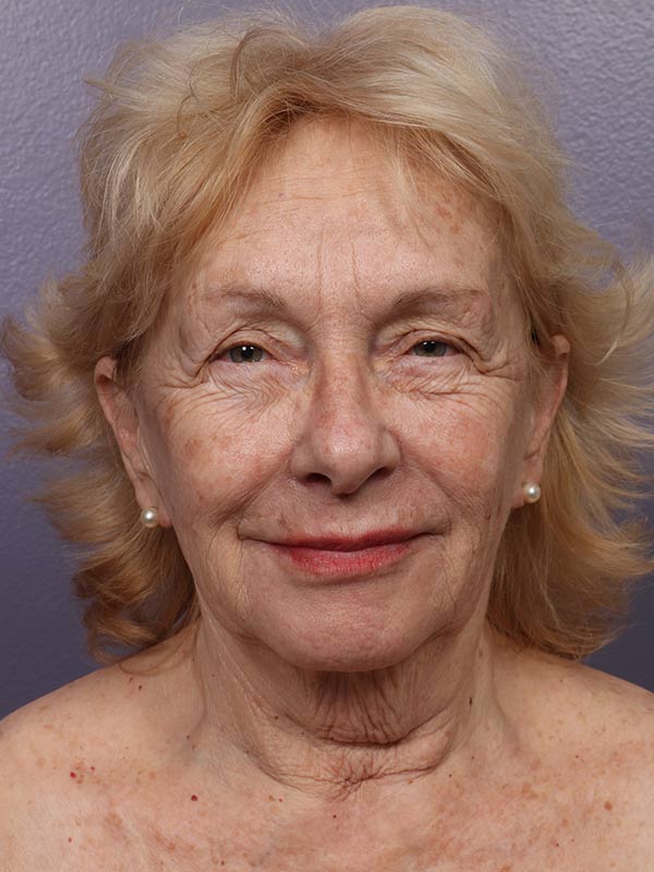 Neck Lift before photo