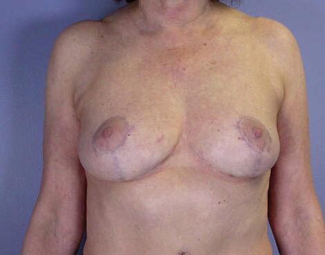 Mommy Makeover result at Marina Plastic Surgery