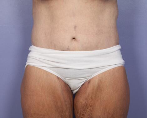 Tummy Tuck result at Marina Plastic Surgery