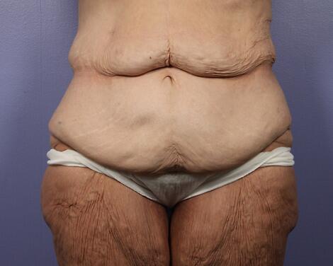 Tummy Tuck before photo
