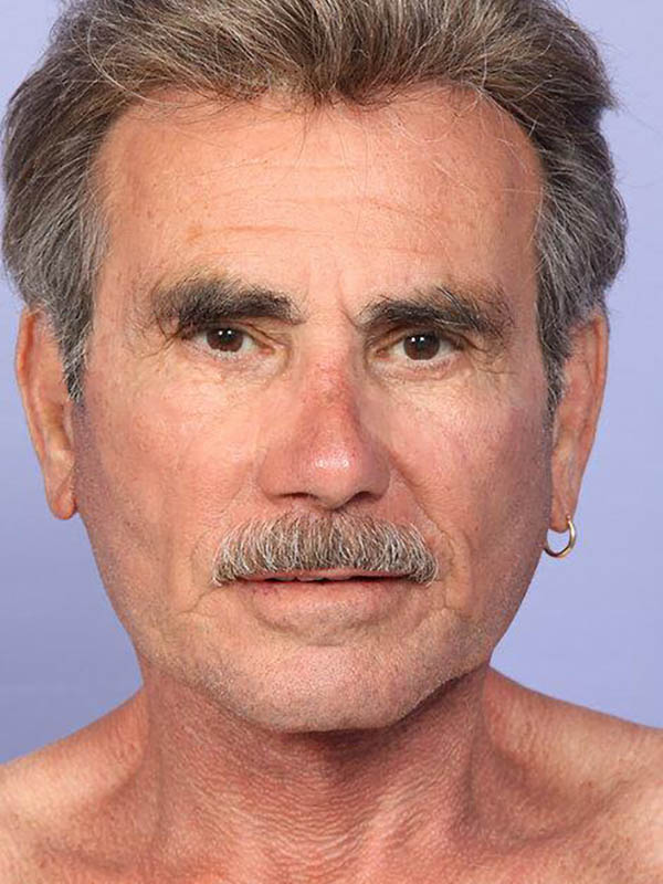 Facelift result at Marina Plastic Surgery