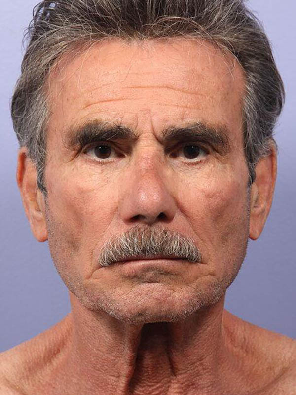 Facelift before photo