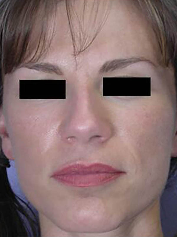 Facelift result at Marina Plastic Surgery