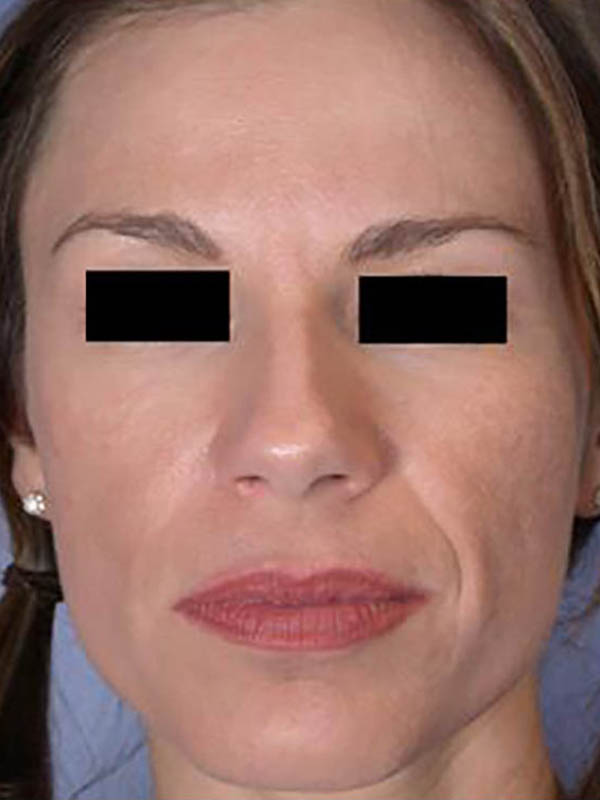 Facelift before photo
