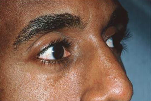 Blepharoplasty result at Marina Plastic Surgery