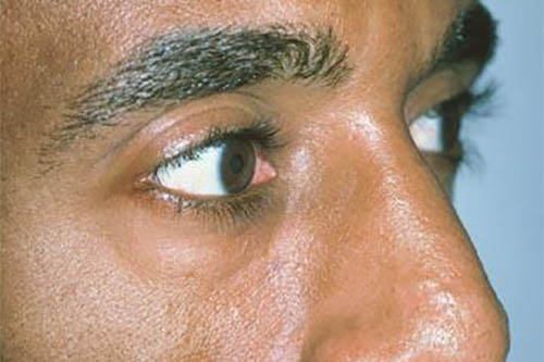 Blepharoplasty before photo