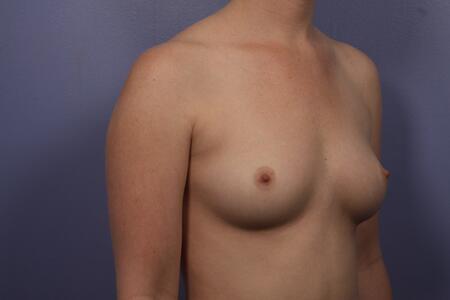 Breast Augmentation before photo
