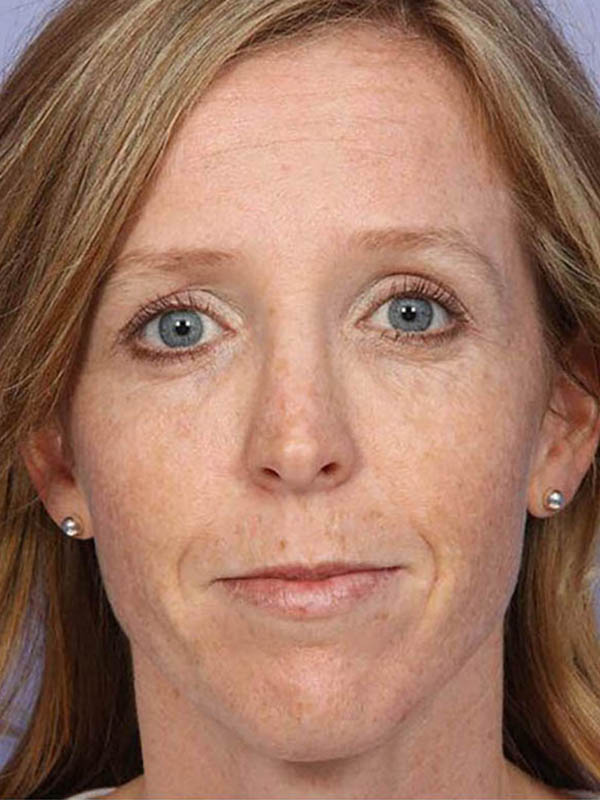 Rhinoplasty result at Marina Plastic Surgery