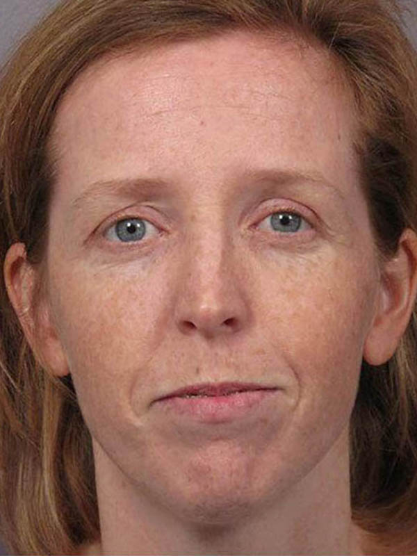 Rhinoplasty before photo