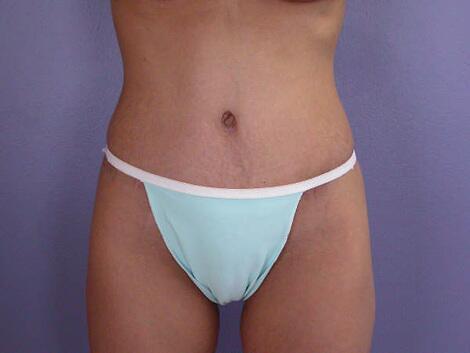 Mommy Makeover result at Marina Plastic Surgery