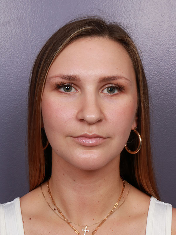 Neck Lift result at Marina Plastic Surgery