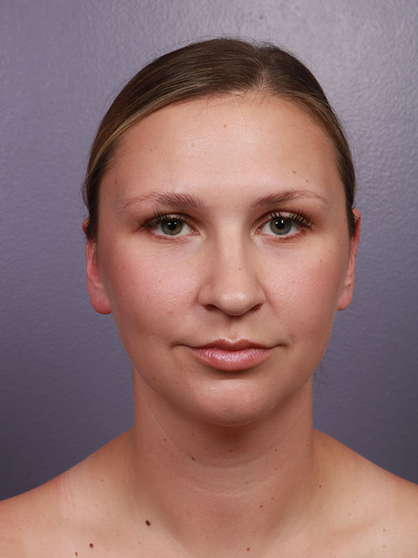 Neck Lift before photo