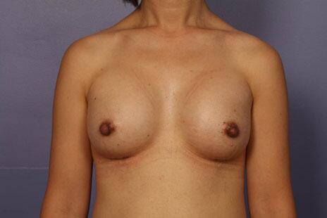 Breast Augmentation result at Marina Plastic Surgery