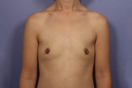 Breast Augmentation before photo