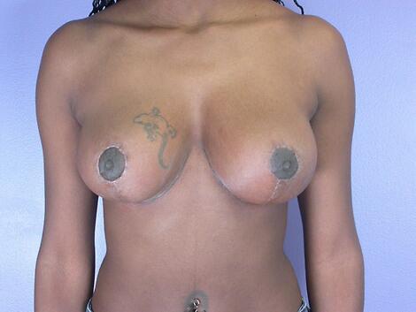 Breast Lift result at Marina Plastic Surgery