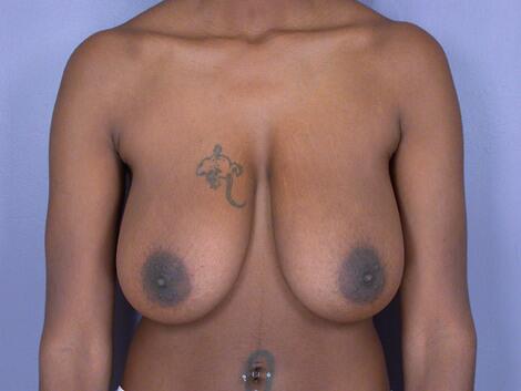 Breast Lift before photo