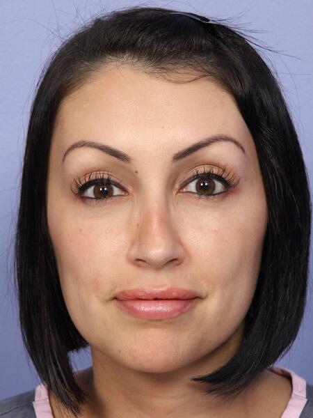 Rhinoplasty result at Marina Plastic Surgery