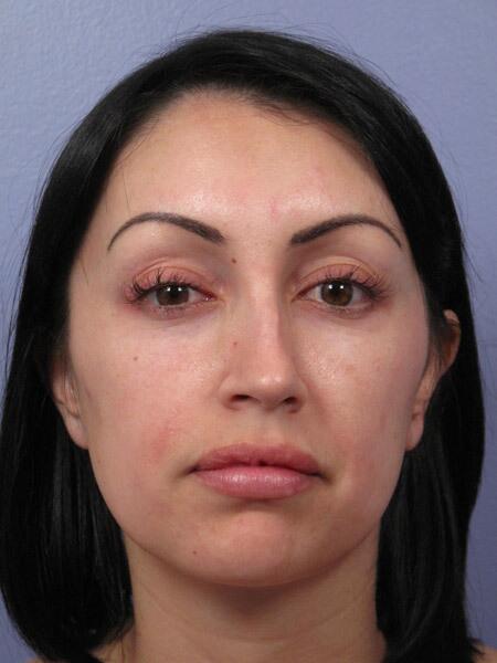 Rhinoplasty before photo