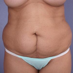 Tummy Tuck before photo