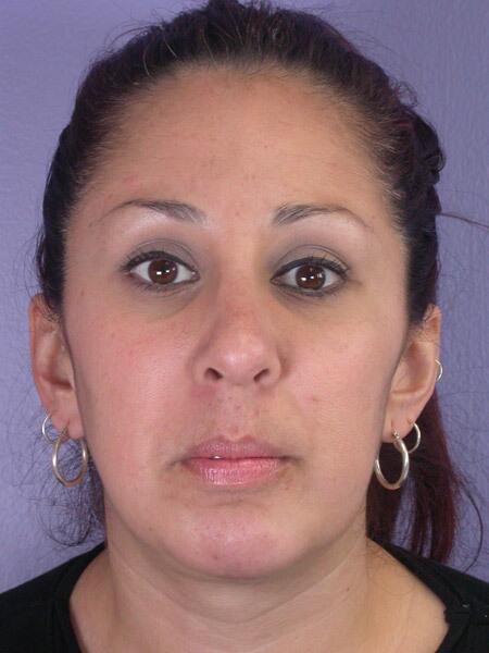 Rhinoplasty result at Marina Plastic Surgery