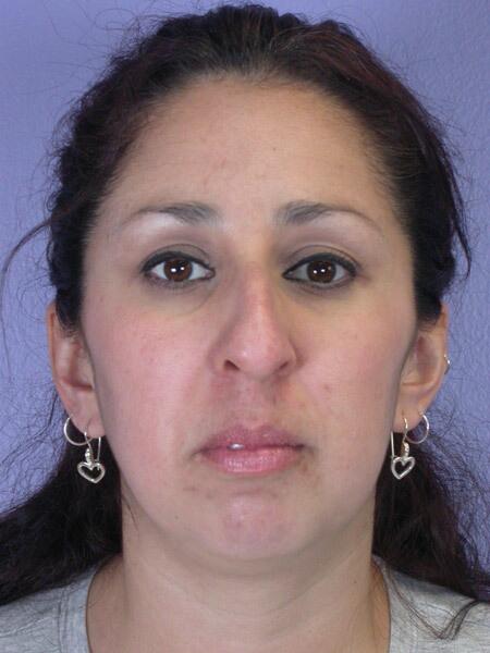 Rhinoplasty before photo