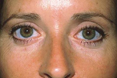 Blepharoplasty result at Marina Plastic Surgery