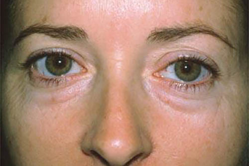 Blepharoplasty before photo