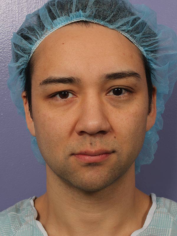 Neck Lift before photo