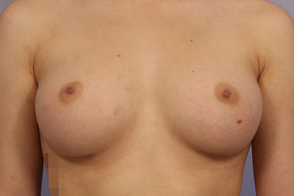 Breast Augmentation result at Marina Plastic Surgery