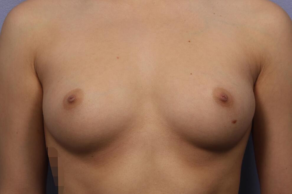 Breast Augmentation before photo