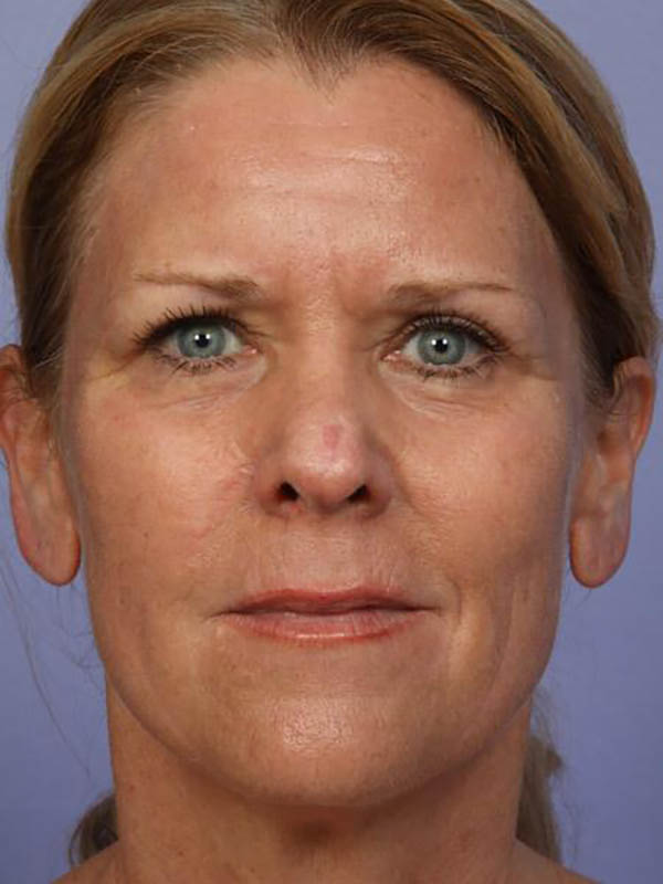 Blepharoplasty result at Marina Plastic Surgery