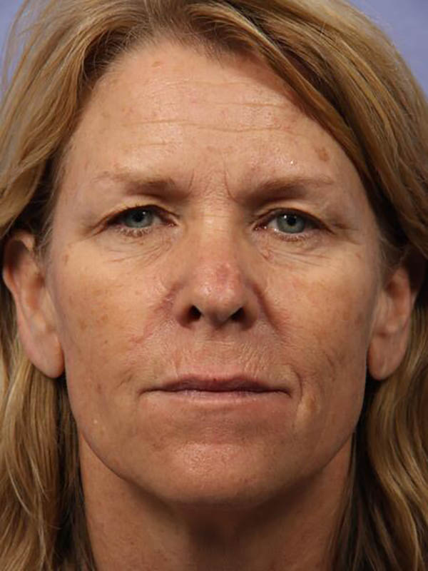 Blepharoplasty before photo