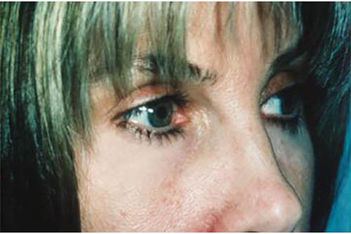Blepharoplasty result at Marina Plastic Surgery